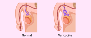 varicocèle testiculaire