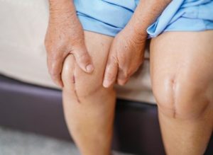 Lire la suite à propos de l’article Traitement arthrose du genou : ces méthodes naturelles qui marchent