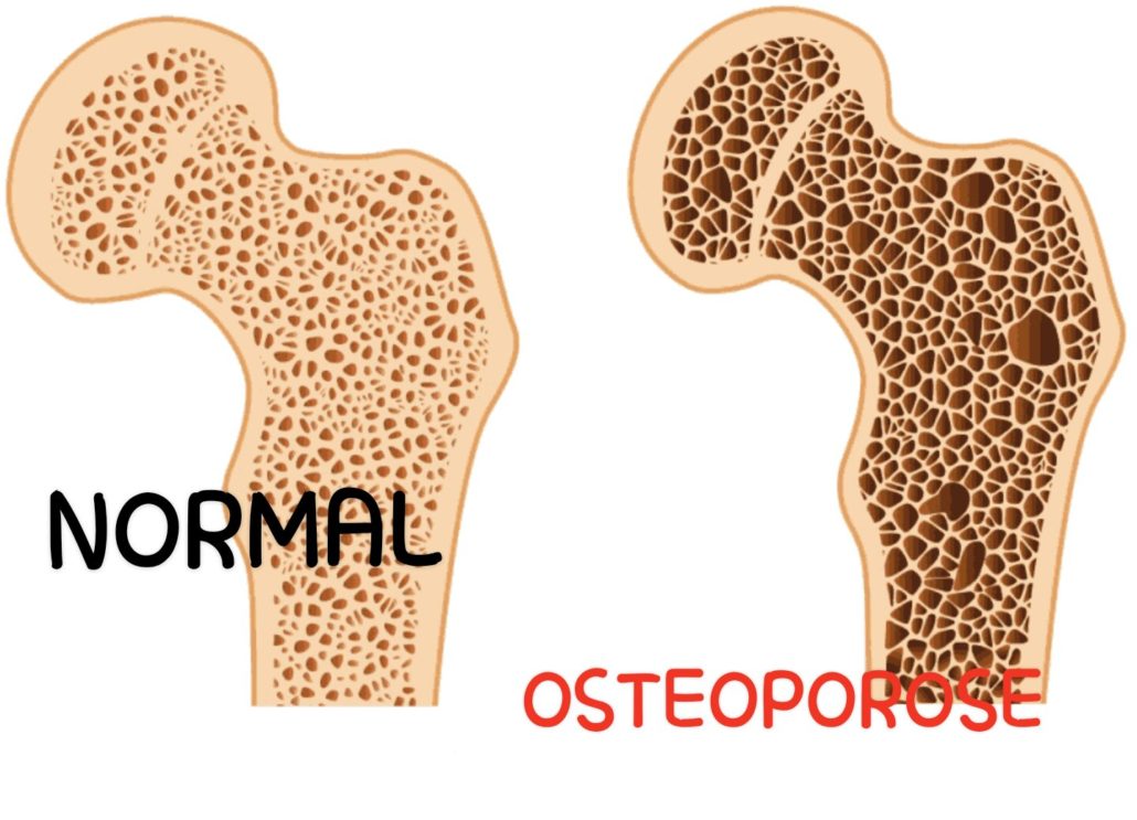 Lire la suite à propos de l’article Ostéoporose causes et complications : Comprendre le Mal