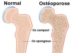 Ostéoporose causes et complications