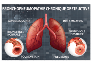 Broncho-pneumopathie traitement naturel