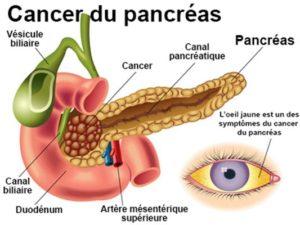 Cancer du pancréas traitement naturel