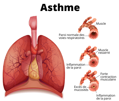 You are currently viewing Asthme Traitement Naturel : La Force des Plantes Médicinales !