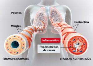 Asthme traitement naturel