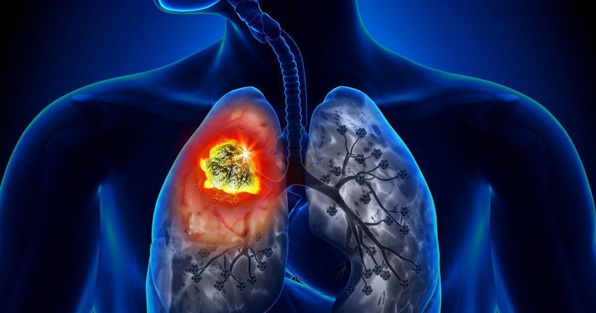 You are currently viewing Cancer du Poumon : Le Traitement Naturel Magique