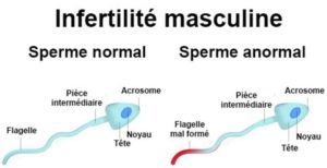 Infertilité masculine solution.