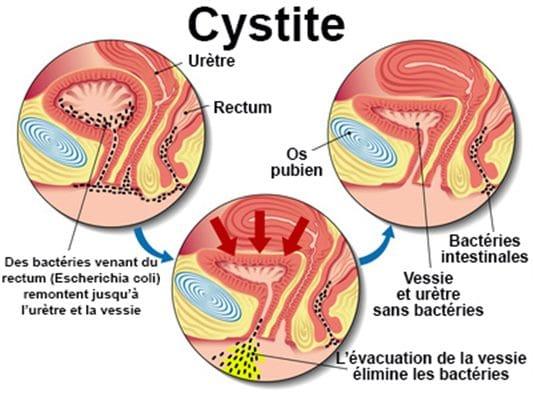 Lire la suite à propos de l’article Origine signe et traitement de la Cystite