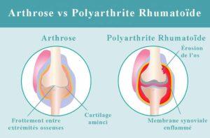 Signe traitement: Polyarthrite Rhumatoïde