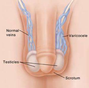 Varicocèle testiculaire