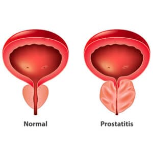Cancer de la prostate complication et traitement.