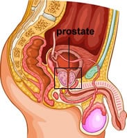 Lire la suite à propos de l’article Cancer de la prostate traitement