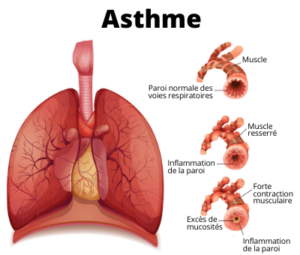 Asthme traitement naturel.
