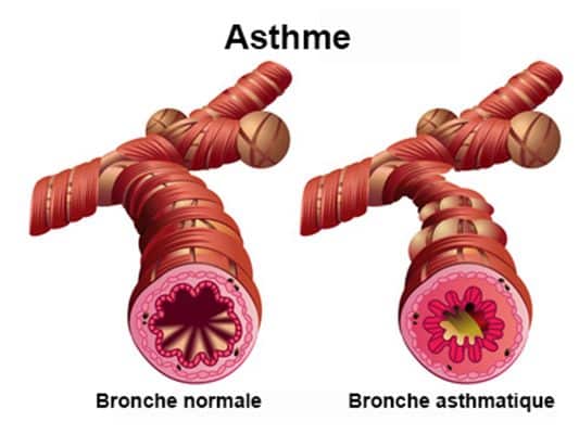 Lire la suite à propos de l’article Asthme: Stop par les plantes