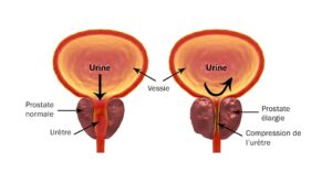 Adénome de la Prostate cause et traitement