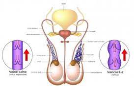 Varicocèle testiculaire traitement naturel