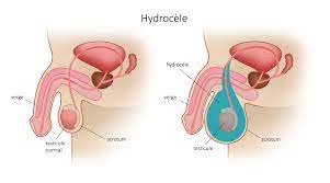 Lire la suite à propos de l’article Quels sont les causes et conséquences d’Hydrocèle testiculaire ?