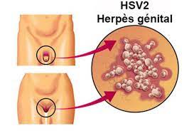 Herpès génital cause et traitement