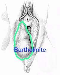 Traitement Bartholinite sans chirurgie