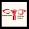 Kyste ovarien grossesse