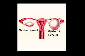 Lire la suite à propos de l’article Complication et traitement des Kystes ovarien