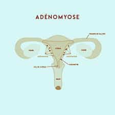 You are currently viewing Adénomyose tout ce qu’il faut savoir ?