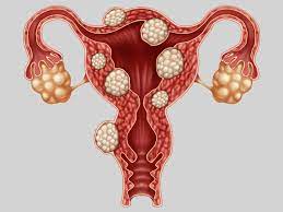 Lire la suite à propos de l’article Cause et Conséquence de l’endométriose
