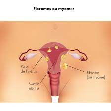 Fibromes utérins symptômes