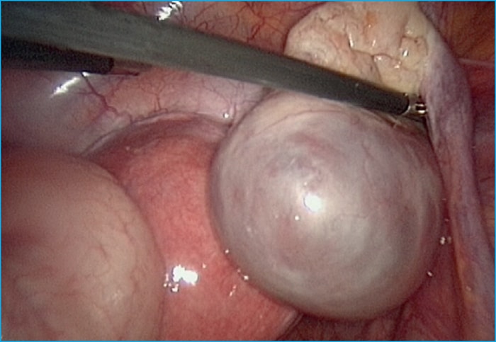 You are currently viewing Kyste de l’ovaire: quels sont les causes et les traitements ?