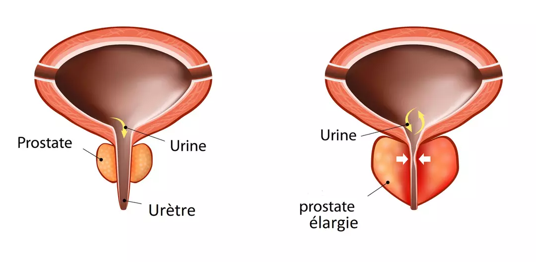 You are currently viewing La prostatite qu’est-ce que c’est ? Un traitement naturel
