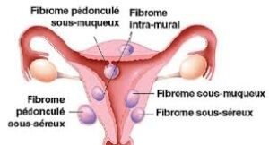 Un fibrome peut-il cacher une grossesse