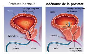 Lire la suite à propos de l’article Adénome de la prostate qu’est-ce que c’est ?