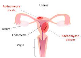 You are currently viewing Adénomyose symptôme et traitement