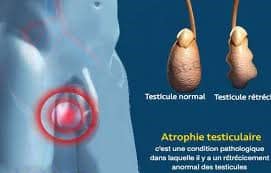 Atrophie testiculaire traitement naturel