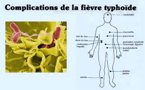 Fièvre Typhoïde symptômes
