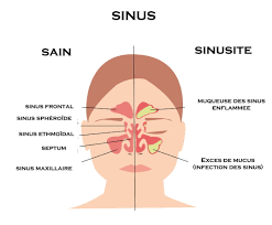 Soigner naturellement la sinusite