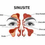Sinusite traitement naturel