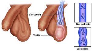 Varicocèle testiculaire symptôme