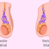 Varicocèle testiculaire symptôme