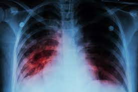 Soigner naturellement la Tuberculose