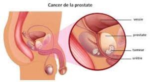 Cause et symptôme du cancer de la prostate