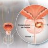 Cause et symptôme du cancer de la prostate