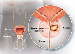Lire la suite à propos de l’article Tout savoir sur le cancer de la Prostate.