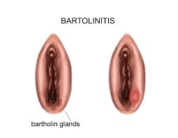 Bartholinite soigner naturellement