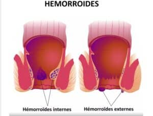 Remède arabe contre les hémorroïdes