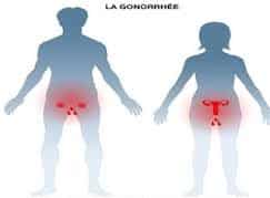 Gonorrhée remède naturel