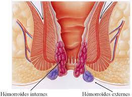 Lire la suite à propos de l’article Hémorroïde causes et symptômes