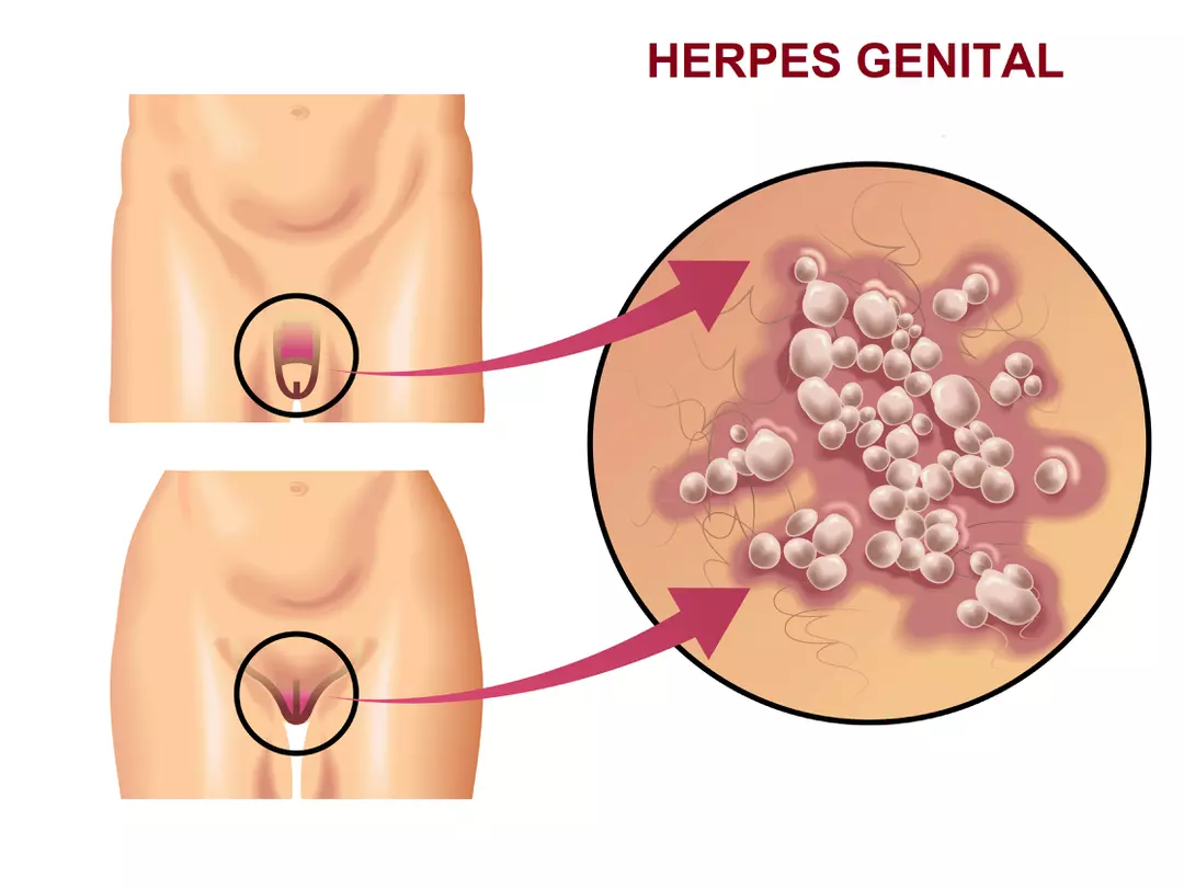 Lire la suite à propos de l’article Herpès Génital traitement: Se relever de cette maladie