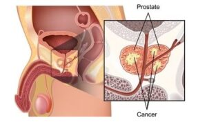 cancer de la prostate traitement