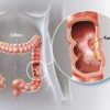 Cancer de l'intestin: quelques remèdes