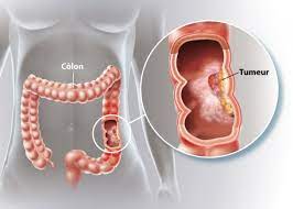 Cancer de l'intestin: quelques remèdes